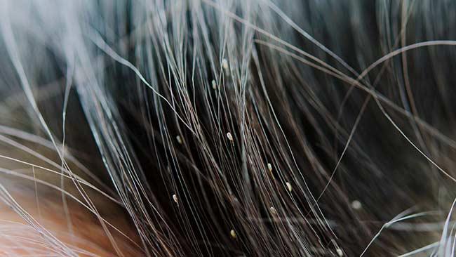 درمان شپش موی سر به روش خانگی، سریع و آسان